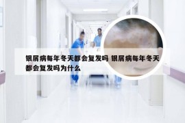 银屑病每年冬天都会复发吗 银屑病每年冬天都会复发吗为什么