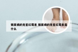银屑病的克星红霉素 银屑病的克星红霉素是什么