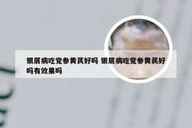 银屑病吃党参黄芪好吗 银屑病吃党参黄芪好吗有效果吗