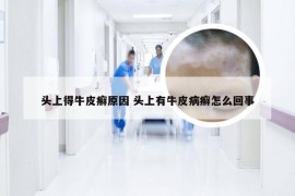 头上得牛皮癣原因 头上有牛皮病癣怎么回事
