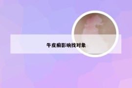牛皮癣影响找对象