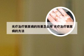 光疗治疗银屑病的效果怎么样 光疗治疗银屑病的方法