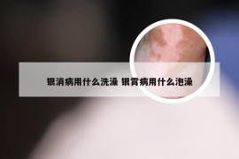 银消病用什么洗澡 银霄病用什么泡澡