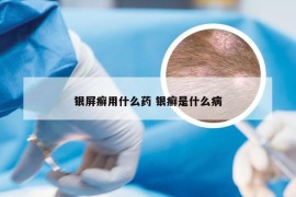 银屏癣用什么药 银癣是什么病