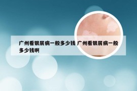 广州看银屑病一般多少钱 广州看银屑病一般多少钱啊