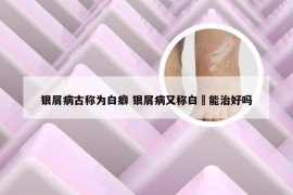 银屑病古称为白癖 银屑病又称白疕能治好吗