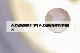 身上起癣需要忌口吗 身上起癣需要忌口吗图片