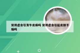 肾阴虚会引发牛皮癣吗 肾阴虚会引起皮肤干燥吗