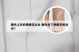 额头上长的像癣怎么办 额头长了块癣怎样治疗?