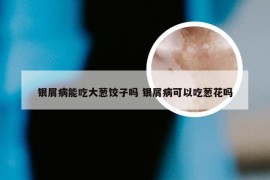 银屑病能吃大葱饺子吗 银屑病可以吃葱花吗