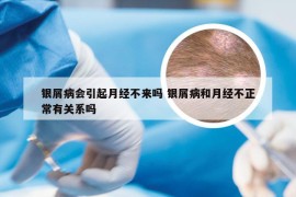 银屑病会引起月经不来吗 银屑病和月经不正常有关系吗