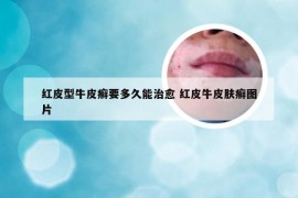 红皮型牛皮癣要多久能治愈 红皮牛皮肤癣图片