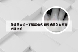 能简单介绍一下银屑病吗 银屑病是怎么回事啊能治吗