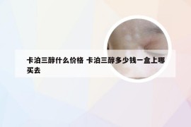 卡泊三醇什么价格 卡泊三醇多少钱一盒上哪买去
