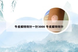 牛皮癣特效针一针3000 牛皮廨特效针