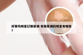 好莱坞明星们银屑病 有银屑病的明星有哪些?