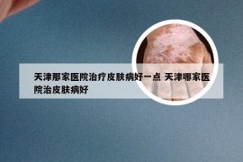 天津那家医院治疗皮肤病好一点 天津哪家医院治皮肤病好