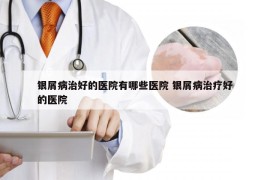 银屑病治好的医院有哪些医院 银屑病治疗好的医院
