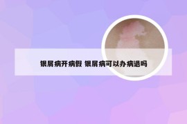 银屑病开病假 银屑病可以办病退吗