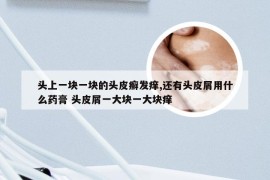 头上一块一块的头皮癣发痒,还有头皮屑用什么药膏 头皮屑一大块一大块痒