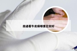 南通看牛皮癣哪里比较好