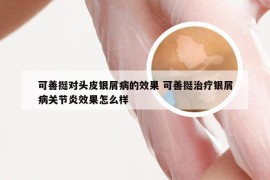 可善挺对头皮银屑病的效果 可善挺治疗银屑病关节炎效果怎么样