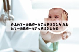 身上长了一些像癣一样的皮肤该怎么办 身上长了一些像癣一样的皮肤该怎么办呢