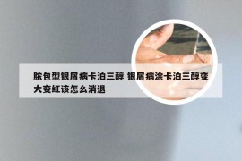 脓包型银屑病卡泊三醇 银屑病涂卡泊三醇变大变红该怎么消退