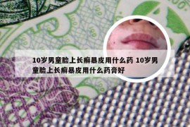 10岁男童脸上长癣暴皮用什么药 10岁男童脸上长癣暴皮用什么药膏好