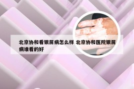 北京协和看银屑病怎么样 北京协和医院银屑病谁看的好