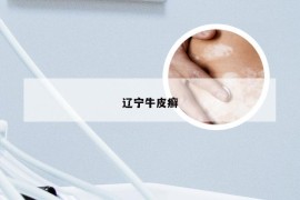 辽宁牛皮癣