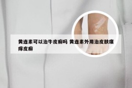 黄连素可以治牛皮癣吗 黄连素外用治皮肤瘙痒皮癣