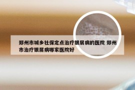 郑州市城乡社保定点治疗银屑病的医院 郑州市治疗银屑病哪家医院好