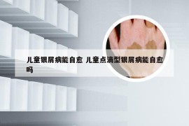 儿童银屑病能自愈 儿童点滴型银屑病能自愈吗