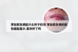 掌趾脓包病起什么样子的泡 掌趾脓包病的脓包越起越少,是快好了吗
