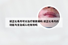 修正化毒丹可以治疗银屑病吗 修正化毒丹的功能与主治成人吃有效吗