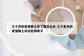 三个月的宝宝脚上长了癣怎么办 三个多月的宝宝脚上长红色得疹子