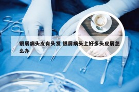 银屑病头皮有头发 银屑病头上好多头皮屑怎么办