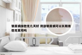 银屑病抹他克几天好 阴部银屑病可以长期用他克莫司吗