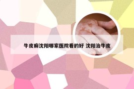 牛皮癣沈阳哪家医院看的好 沈阳治牛皮