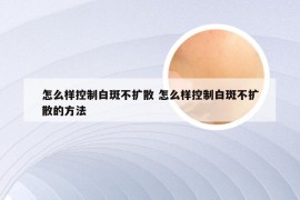 怎么样控制白斑不扩散 怎么样控制白斑不扩散的方法