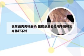 银屑病天天喝鲜奶 银屑病患者能喝牛奶吗对身体好不好