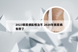 2023银屑病能根治不 2020年银屑病有救了