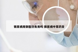 银屑病用御医彷有用吗 银屑病中草药膏