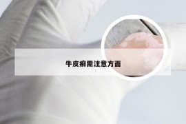 牛皮癣需注意方面