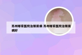 苏州哪家医院治银屑病 苏州哪家医院治银屑病好