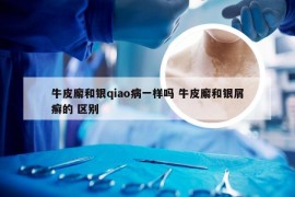 牛皮廨和银qiao病一样吗 牛皮廨和银屑癣的 区别