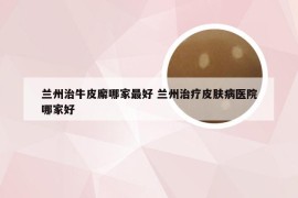 兰州治牛皮廨哪家最好 兰州治疗皮肤病医院哪家好