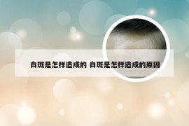 白斑是怎样造成的 白斑是怎样造成的原因