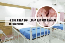 北京哪里看皮肤科比较好 北京哪里看皮肤科比较好的医院